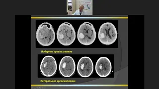 Внутримозговые и субарахноидальные кровоизлияния