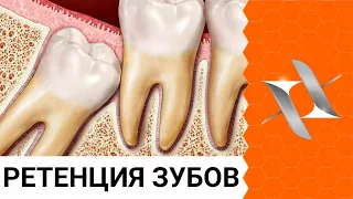 Ретенция зубов. 6 причин почему зубы не прорезаются. Взгляд ортодонта.