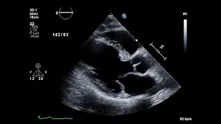 Posterior Mitral Valve Prolapse