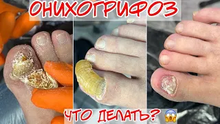 The onychogryphosis ↩️↪️ Wrong turn ⛔ 😯 Crooked growing toenail