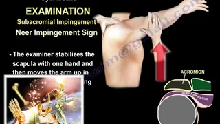 Shoulder Impingement Syndrome  - Everything You Need To Know - Dr. Nabil Ebraheim