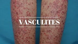 Vasculites | Doenças Autoimunes | Imunologia