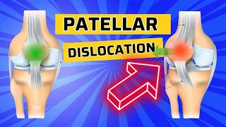Top 3 Exercises after Patellar Dislocation- How to Strengthen the VMO