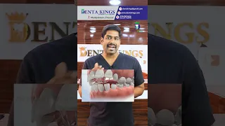 நாக்கைத் துருத்தும் பழக்கம் உள்ளவரா நீங்கள்? Tongue Thrusting | Tongue Crib Appliance | Denta Kings