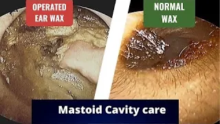 Mastoid cavity  issues  Purpose, Problems, Discharge, Deafness, Dizziness, Dependence