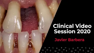 Digital combined perio-implant-crown and injected composite treatment w/ Javier BARBERÁ MILLÁN