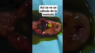 Así se ve un cálculo de la vesícula