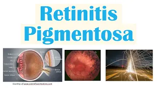 Retinitis Pigmentosa | Genetics, Pathophysiology, Signs & Symptoms, Diagnosis, Treatment