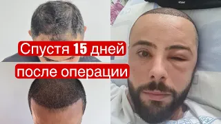 15 ДНЕЙ ПОСЛЕ ПЕРЕСАДКИ ВОЛОС!