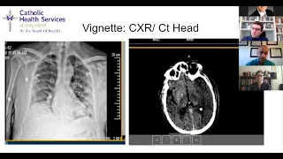 COVID-19 and Stroke: Facts versus Fiction (Part 2)