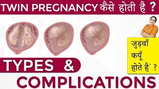 Twins Pregnancy Types, Dichorionic, Conjoined, Monochorionic Diamniotic, Monochorionic Monoamniotic