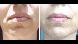 Fight Marionette and Lip Lines with this Quick Exercise