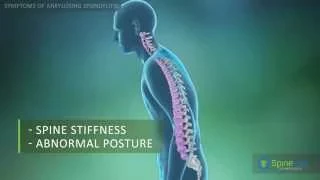 Ankylosing Spondylitis Symptoms