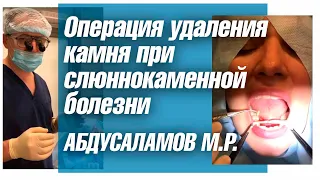 Удаления слюнного камня при слюннокаменной болезни. Профессор  Абдусаламов Магомед Расулович.