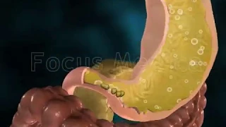 Dysphagia - Animated Atlas of Breast and Gastric Cancer