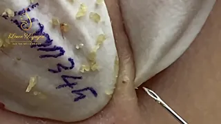 Blackheads and whiteheads removal (345) | Loan Nguyen