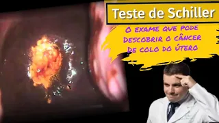 Teste de Schiller - o exame que pode descobrir câncer de colo do útero!