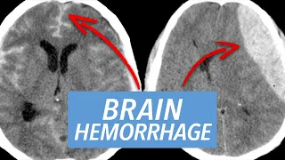 Emergency Radiology Case Series: Acute Emergencies of the Brain