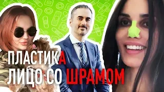 ПЛАСТИКА №6. ПАРЕЗ ЛИЦЕВОГО НЕРВА ПОСЛЕ НАПАДЕНИЯ, ИЗРЕЗАННОЕ ЛИЦО. dr.Sinis