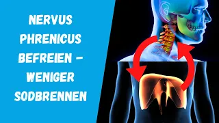 Nervus phrenicus befreien -  weniger Sodbrennen