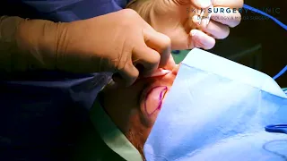 Upper Eyelid Lift Surgery 2022 | Watch the Procedure