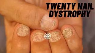 Twenty Nail Dystrophy|Dr Usman Rafiq