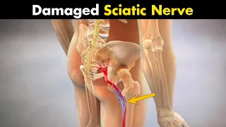 What Happens In Sciatica? - Symptoms, Causes And Treatment (Urdu/Hindi)