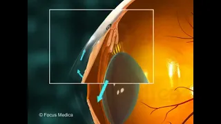 Glaucoma - Overview