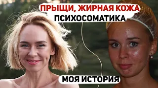 Как я избавилась от прыщей, акне.  Психологические причины почему прыщи не проходят.