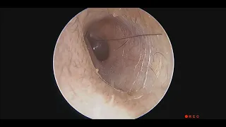 Hair Fragment Touching Eardrum