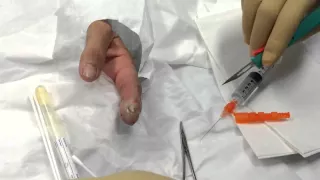 felon finger infection - second edition