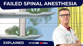 Failed Spinal Anesthesia Explained #1  - Regional anesthesia Crash course with Dr. Hadzic