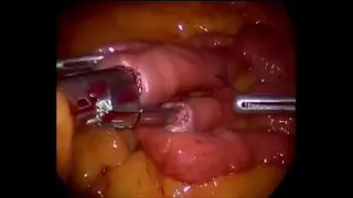 7. Gastric Bypass Surgery