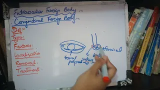 CONJUNCTIVAL FOREIGN BODY simple explanation