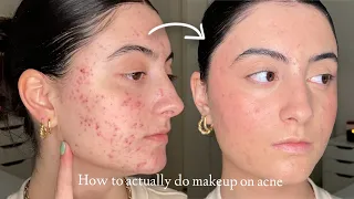 How to Make Makeup Look Smooth & Natural on Acne and Textured Skin