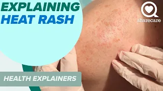 Explaining Heat Rash And How To Treat It | Health Explainers | Sharecare