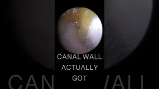 MASSIVE SKIN RIBBON REMOVAL FROM EAR