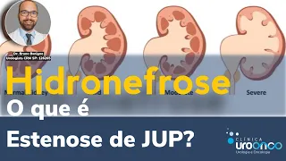 Estenose de JUP (Hidronefrose). Do Diagnóstico ao Tratamento