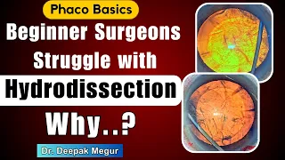 Most Common Mistakes during Hydrodissection Beginner Surgeon.(Phaco Basics) - Dr. Deepak Megur