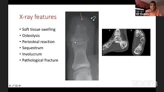 Infections of the Foot and Ankle