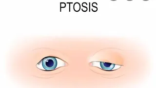 What is Ptosis?, Lecture on eyelid and brow ptosis | ptosis |