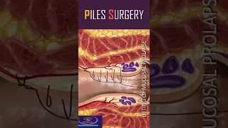 Hemorrhoid Piles Surgery #shorts