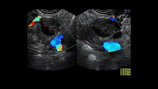 Gynaeological Imaging Part II : Physiological Ovarian Cysts