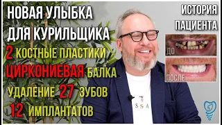 Удалили 27 зубов. Имплантация зубов. Новая улыбка для курильщика. История пациента.