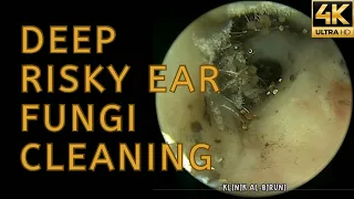 Deep Risky Ear Fungi Cleaning (4K 60FPS)