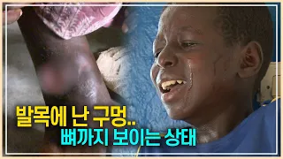 [SBS]세가여 잘못된 치료로 인해 고통 받는 아이들