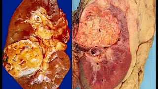 Renal cell carcinoma