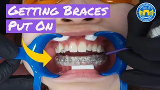 Process of Getting Braces