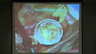 NCMA Spring 2014  Advances in Cardiovascular Surgery with Dr  Joseph Woo
