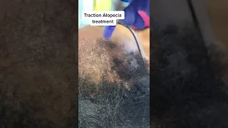 Microneedling Traction alopecia treatment